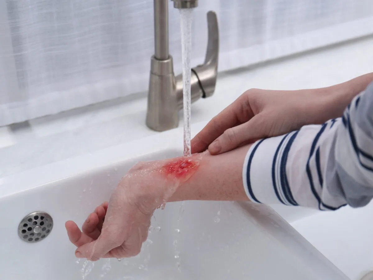 Błędy w pierwszej pomocy przy oparzeniach