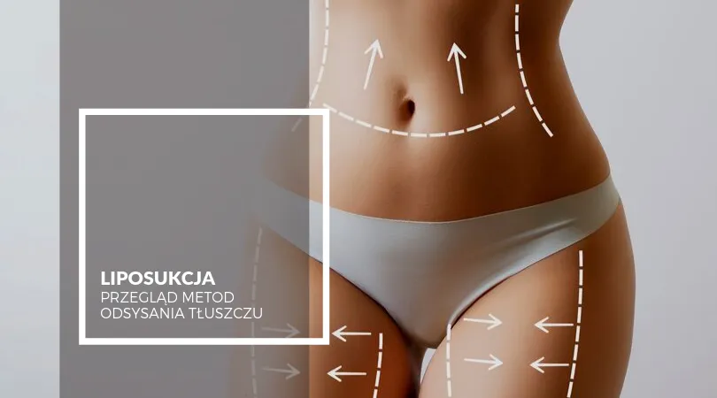 liposukcja obszary zabiegowe schemat