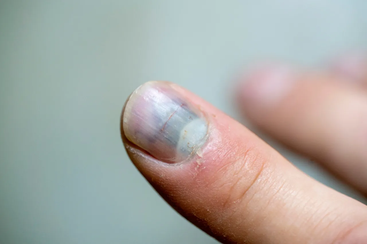 sine paznokcie przyczyny