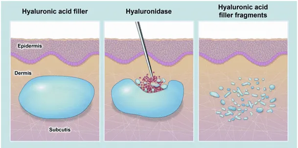 hialuronidaza mechanizm działania enzym rozkład kwasu hialuronowego