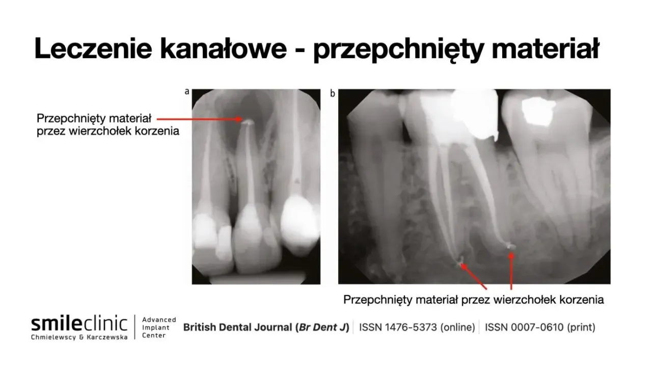 rentgen zęba po leczeniu kanałowym komplikacje