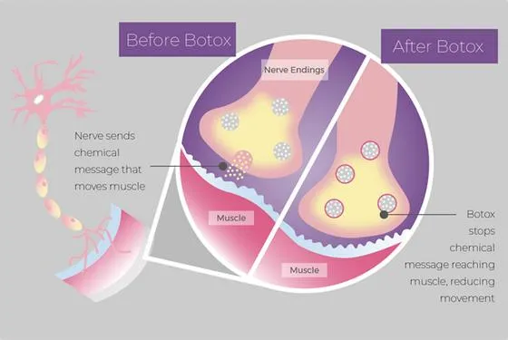mechanizm działania botoksu infografika