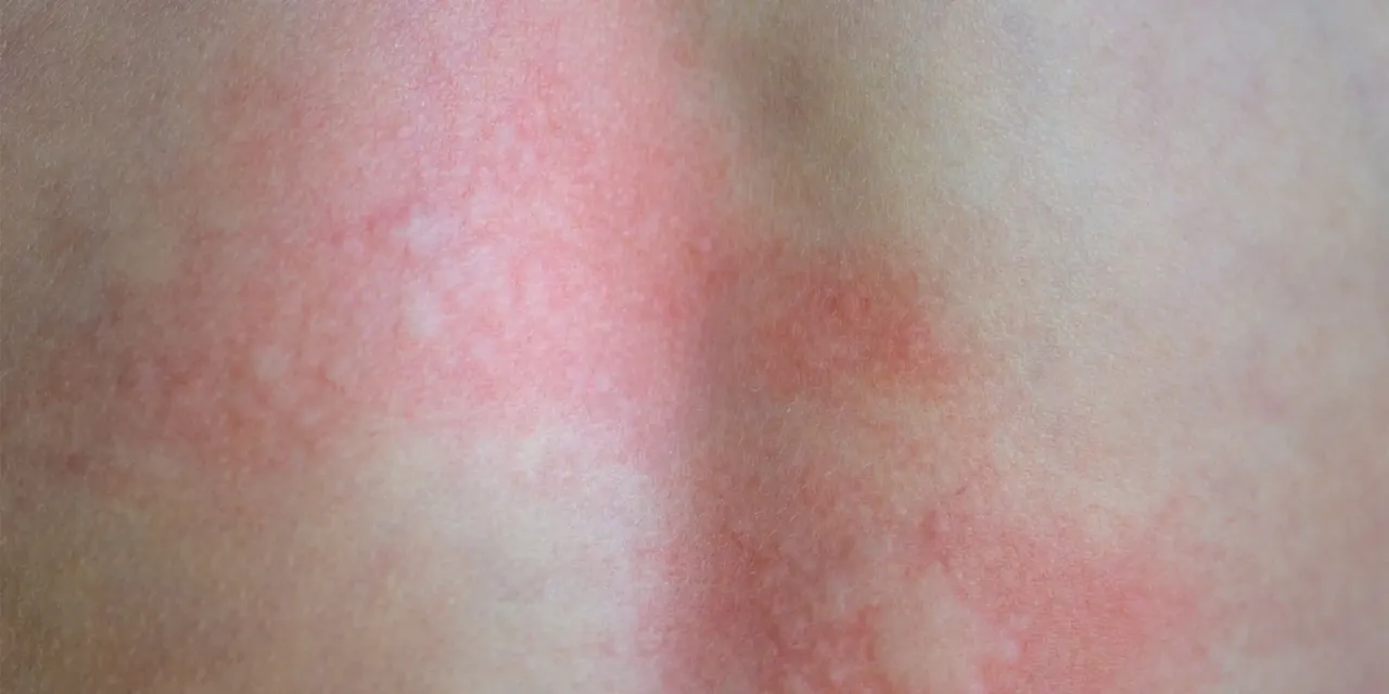Rozległy, czerwony rumień na skórze, który może świadczyć o tym, jak wygląda rumień po kleszczu.