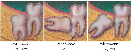 objawy zęba do usunięcia infographic