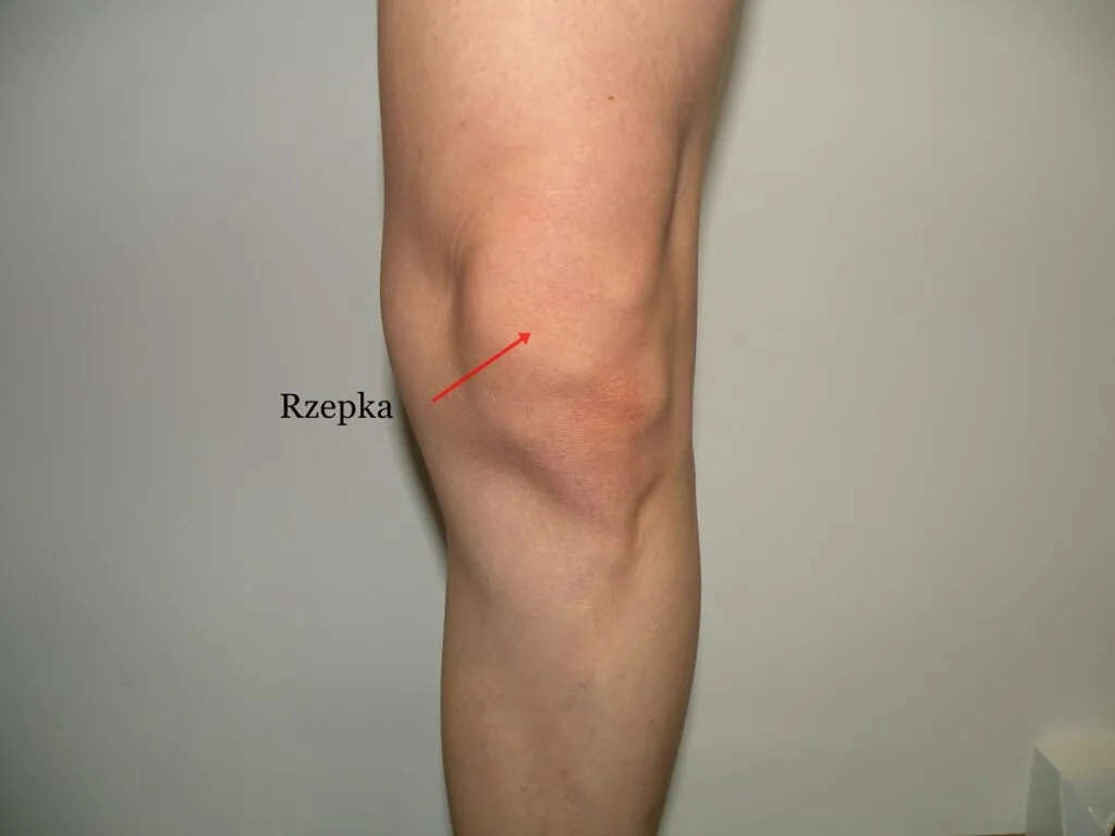 ból kolana lokalizacja rzepka