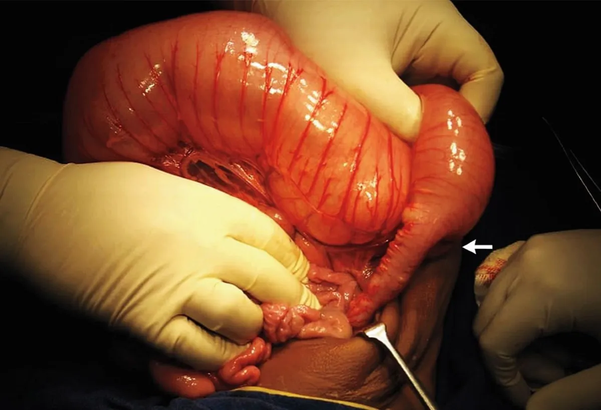 Rektum Saugbiopsie Morbus Hirschsprung