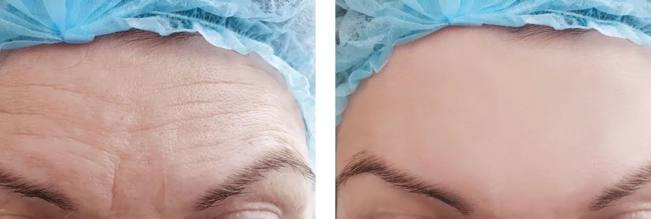 Zabieg botoksu na lwią zmarszczkę