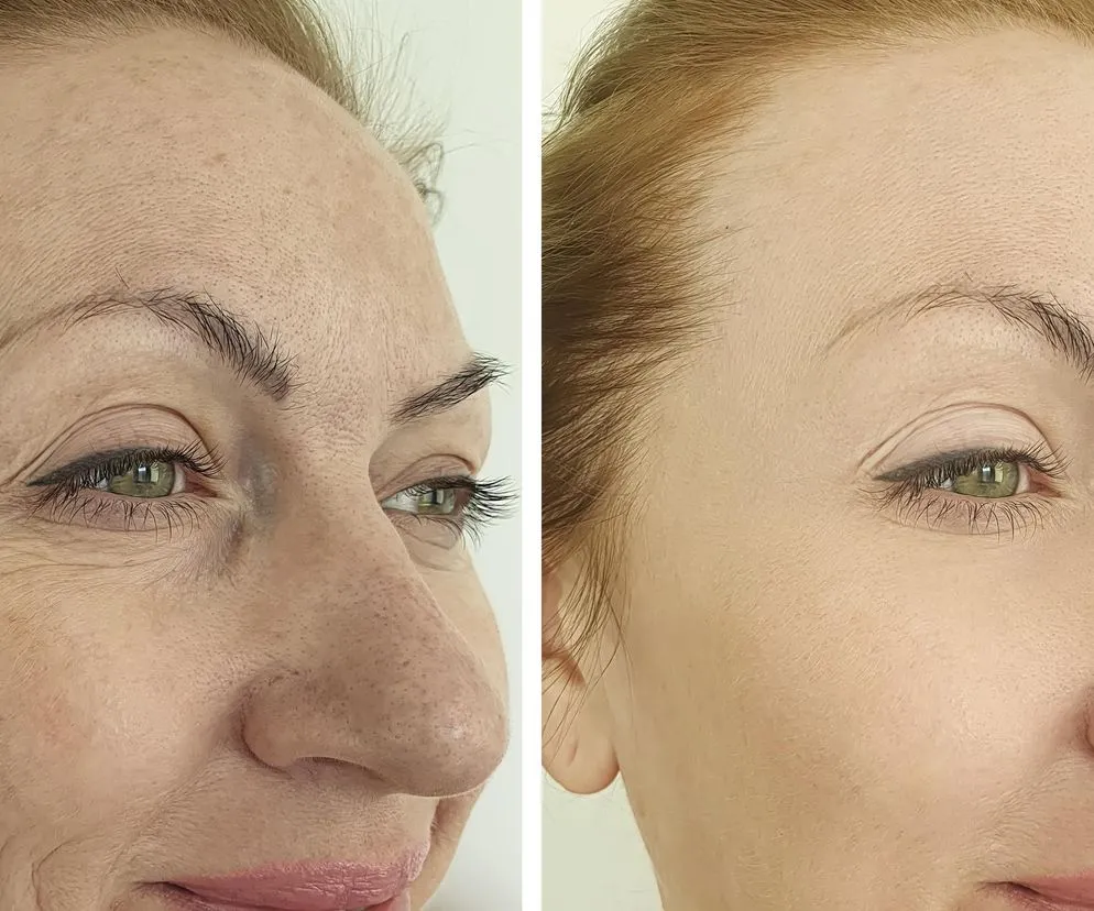 Siemię lniane na twarz efekty