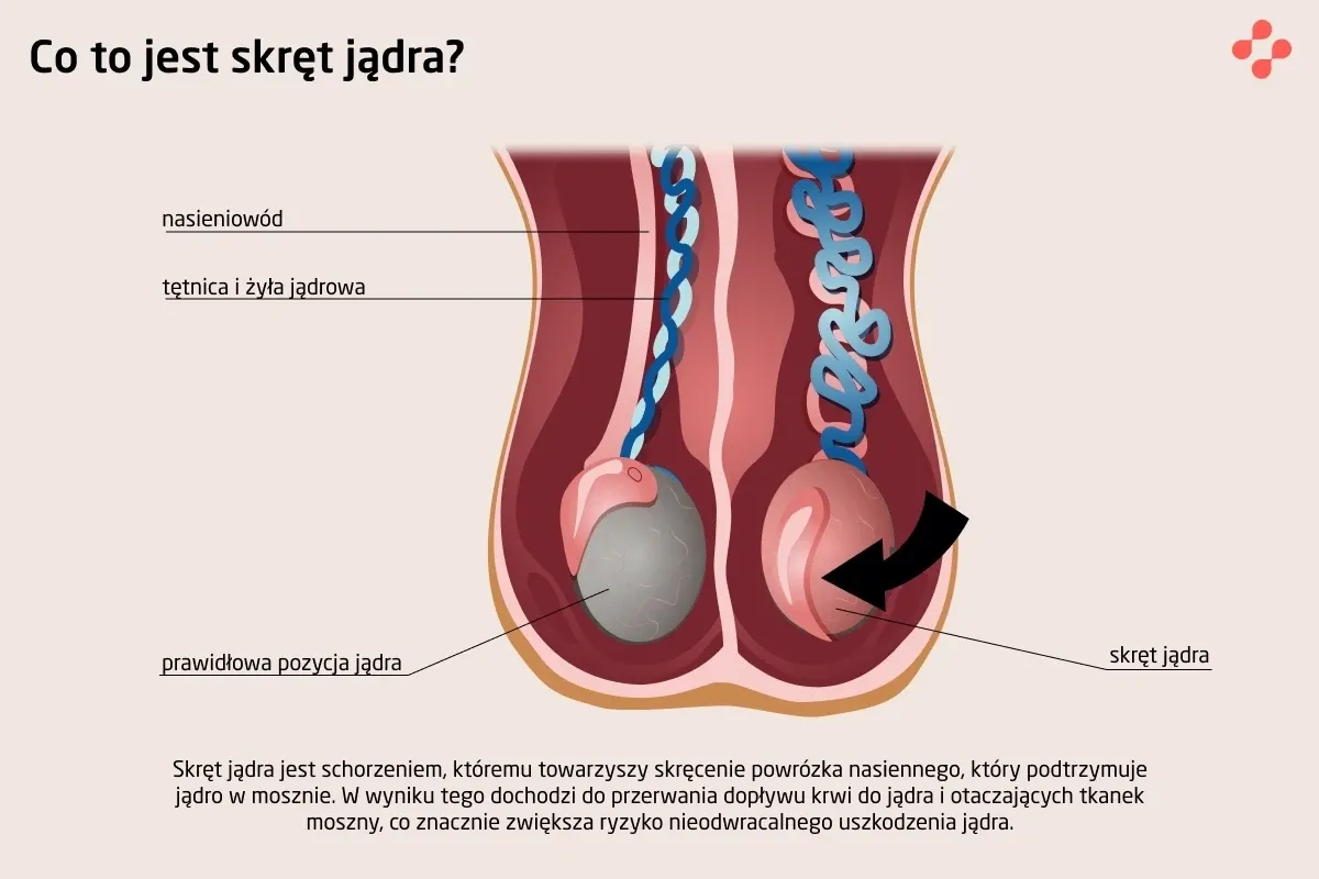 Objawy skrętu jądra