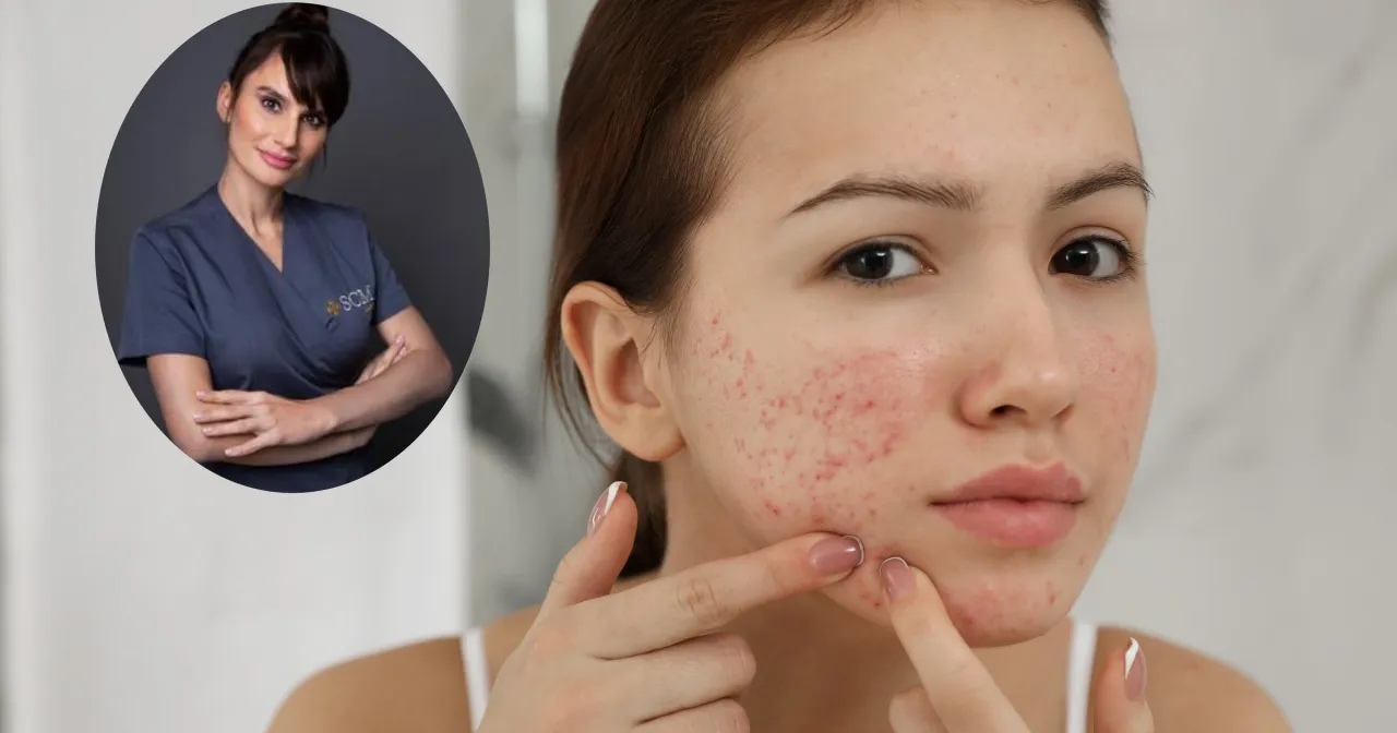 Produkty zakazane w diecie na trądzik