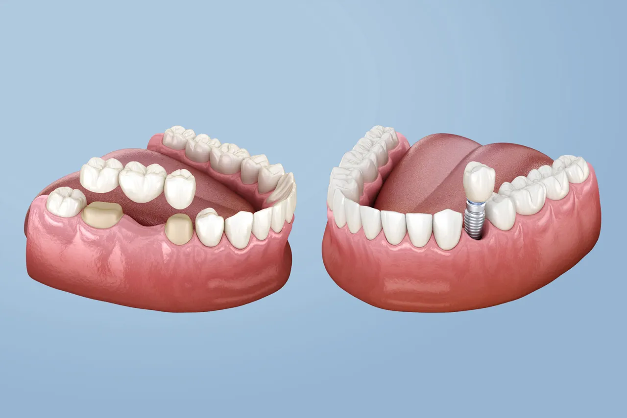 Most protetyczny a implant zęba por&oacute;wnanie