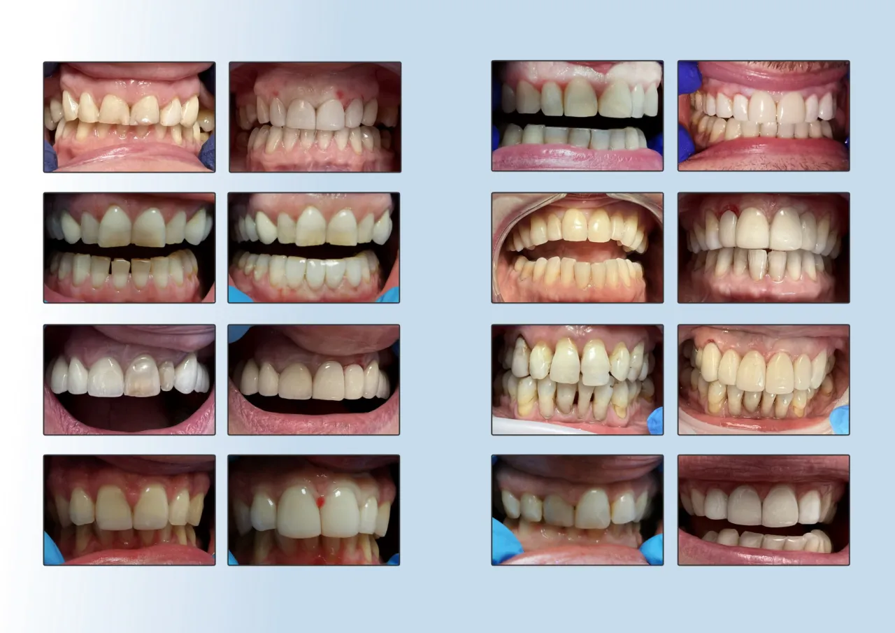 metody odbudowy zęba bonding lic&oacute;wka korona przed i po