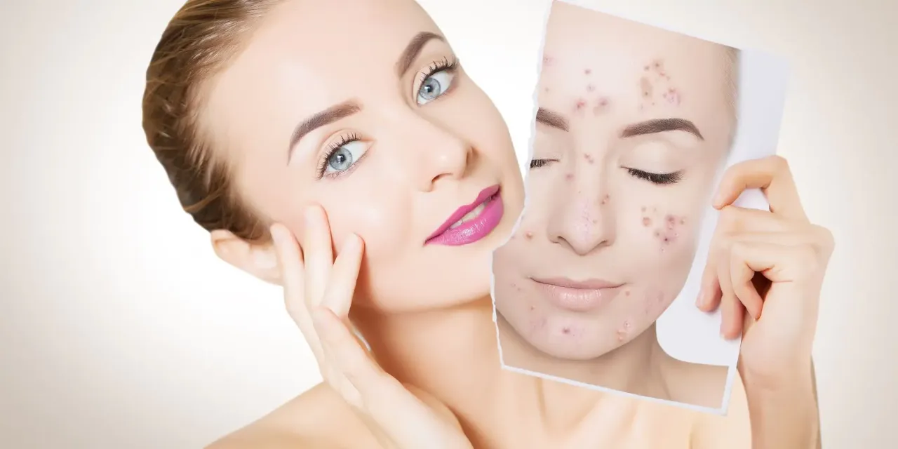 szybkie sposoby na pryszcze, punktowe leczenie trądziku