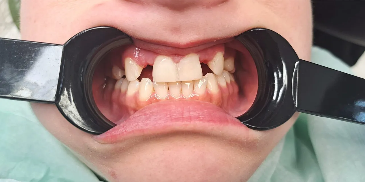 most adhezyjny u dziecka