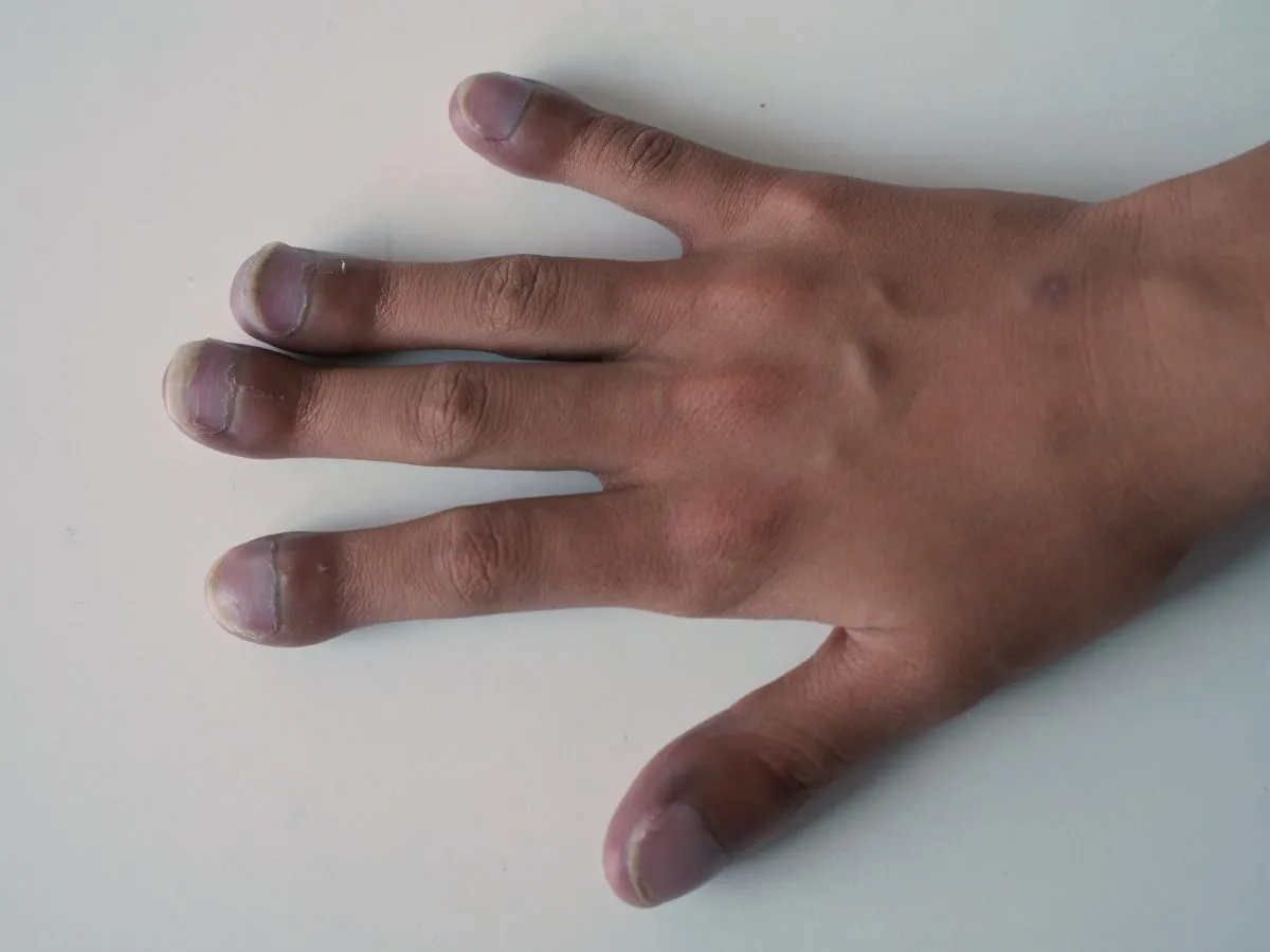 palce spuchnięte od upału, mierzenie palca w r&oacute;żnych warunkach