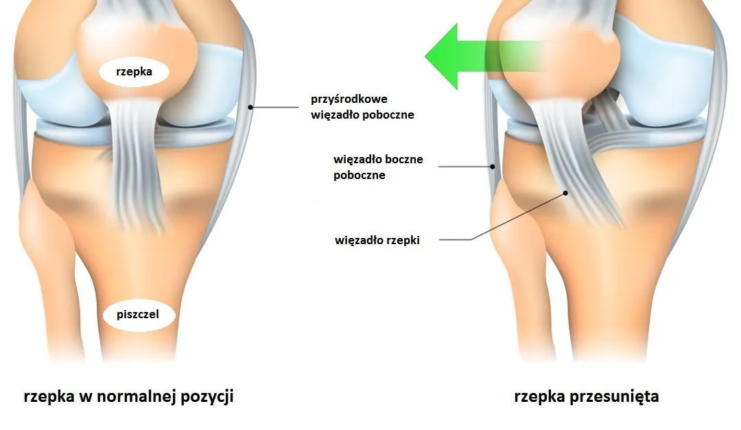 kolano uszkodzona rzepka objawy