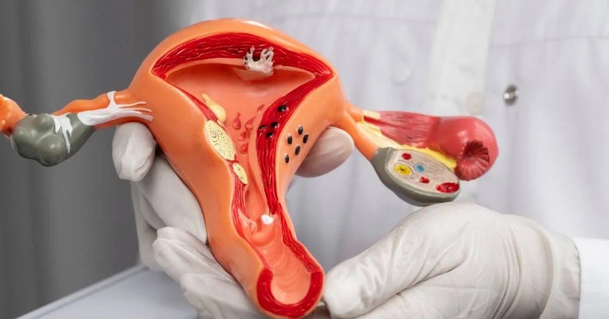 mięśniaki macicy polipy endometrioza