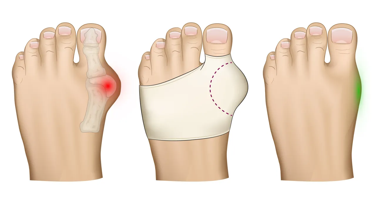 Osoba mierząca odpowiednie obuwie na haluksy