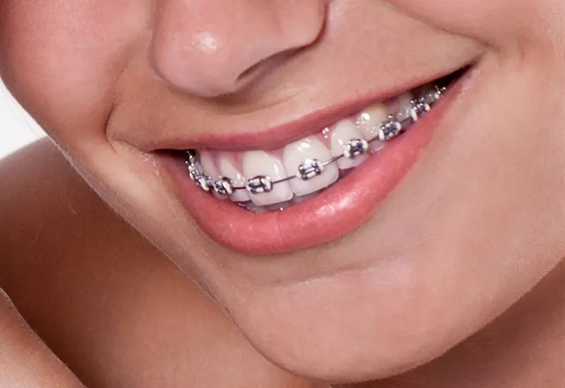 Aparat ortodontyczny na zębach zbliżenie