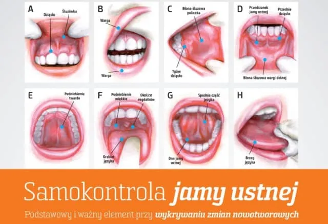 Wizyta u dentysty, diagnostyka raka jamy ustnej, samobadanie jamy ustnej