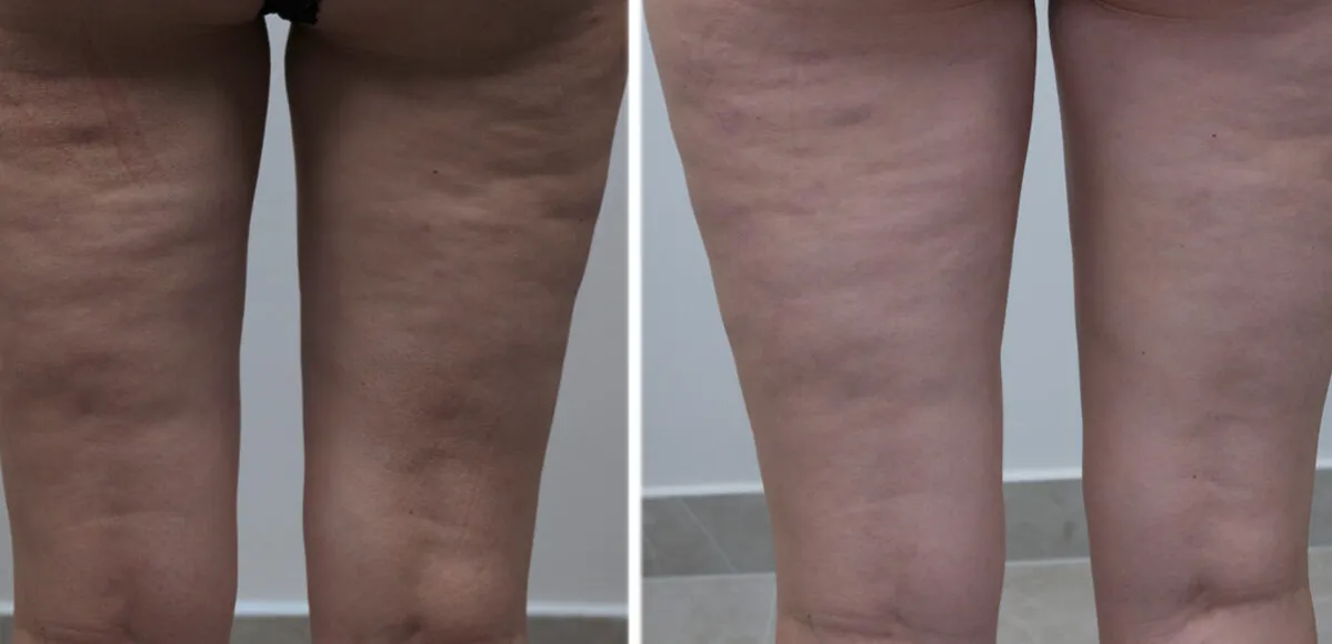 Cellulit na nogach przed i po