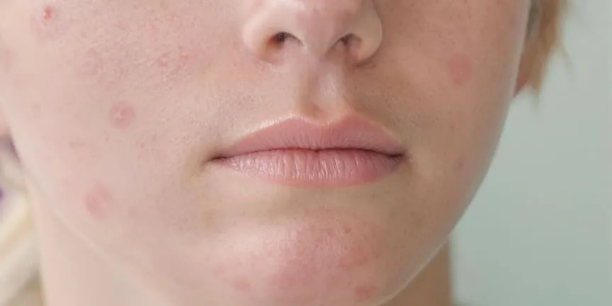 wizyta u dermatologa trądzik młodzieńczy