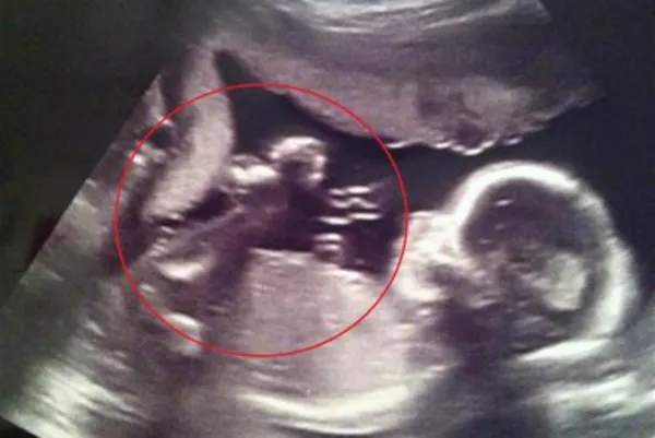 Zdjęcie Pępowina wokół szyi na USG: co to oznacza i jakie niesie ryzyko?