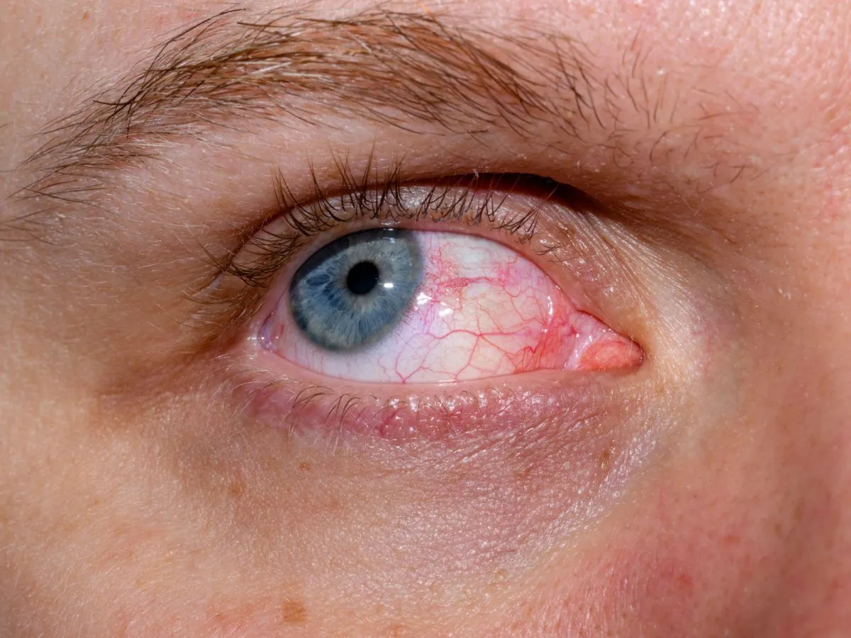 Czerwone oko przyczyny i objawy