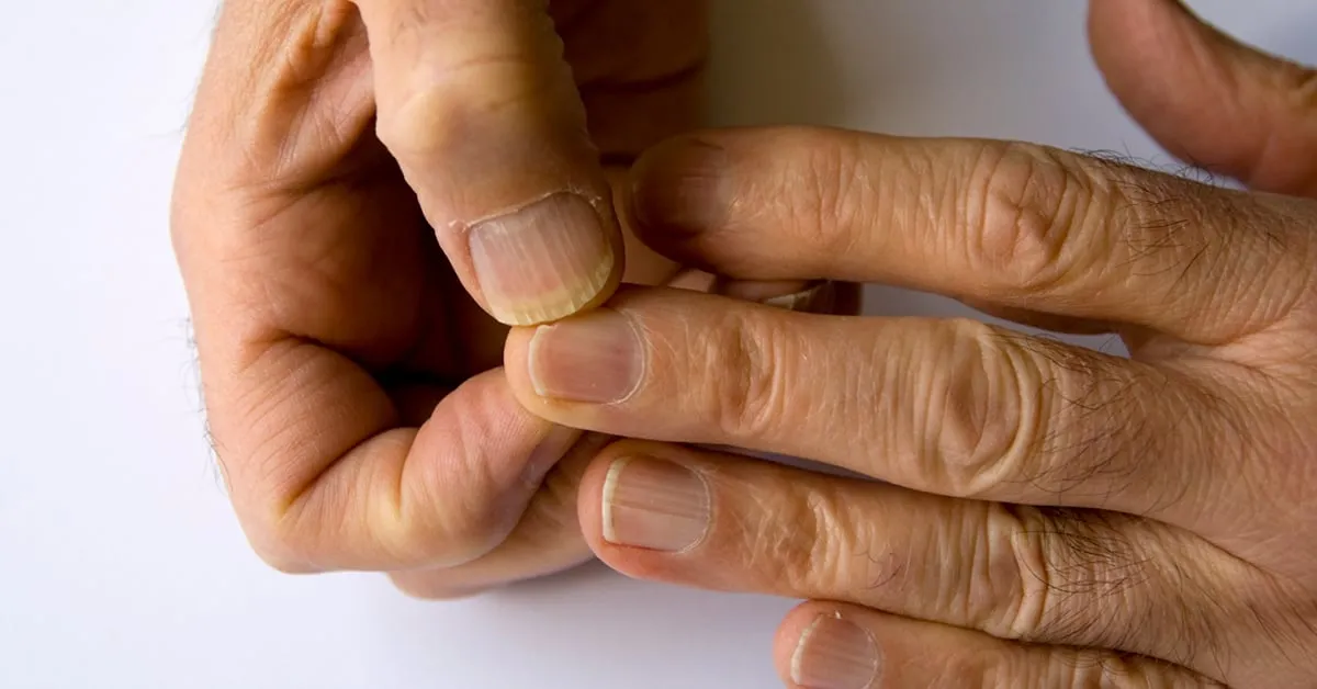 pielęgnacja palca po utracie paznokcia instrukcja