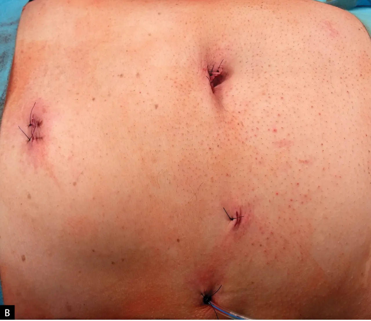 proces gojenia po cholecystektomii laparoskopowej