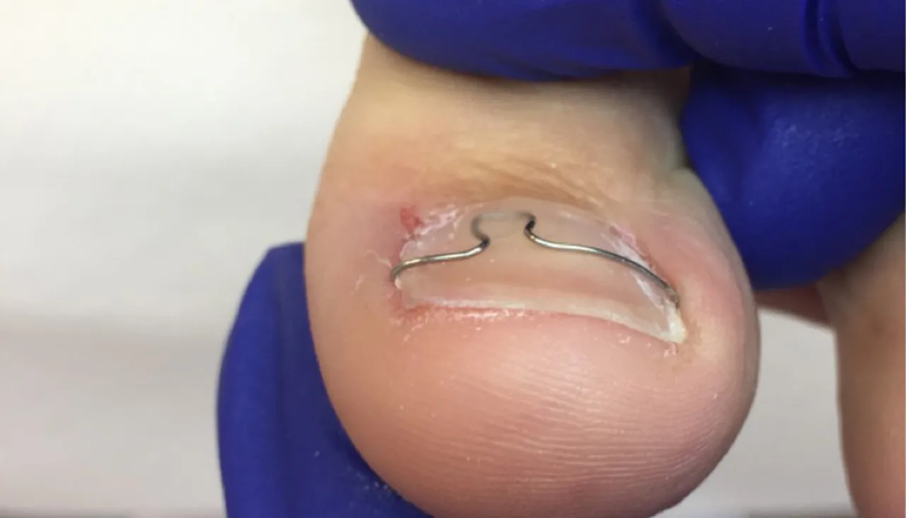 Klamra ortonyksyjna na wrastający paznokieć, podolog zabieg