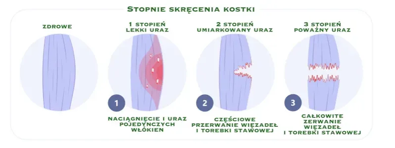 stopnie skręcenia stawu skokowego
