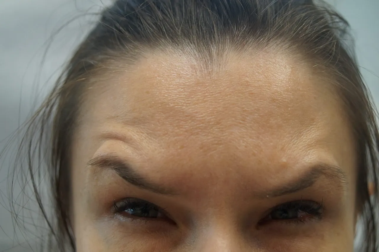 potencjalne skutki uboczne botoksu