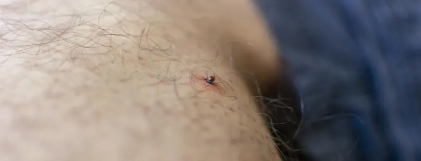 nimfa kleszcza wbita w sk&oacute;rę zdjęcie
