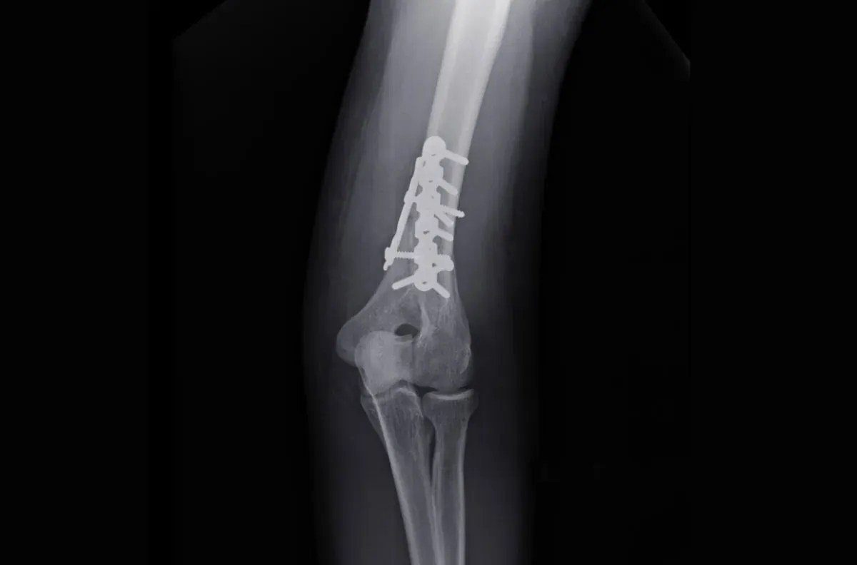 powikłania po złamaniu kości ramiennej