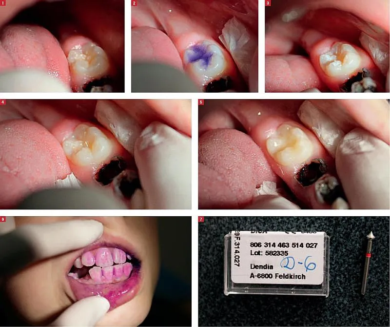 lakowanie zębów u dzieci