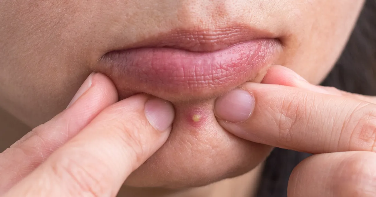 pierwsza pomoc rana po pryszczu