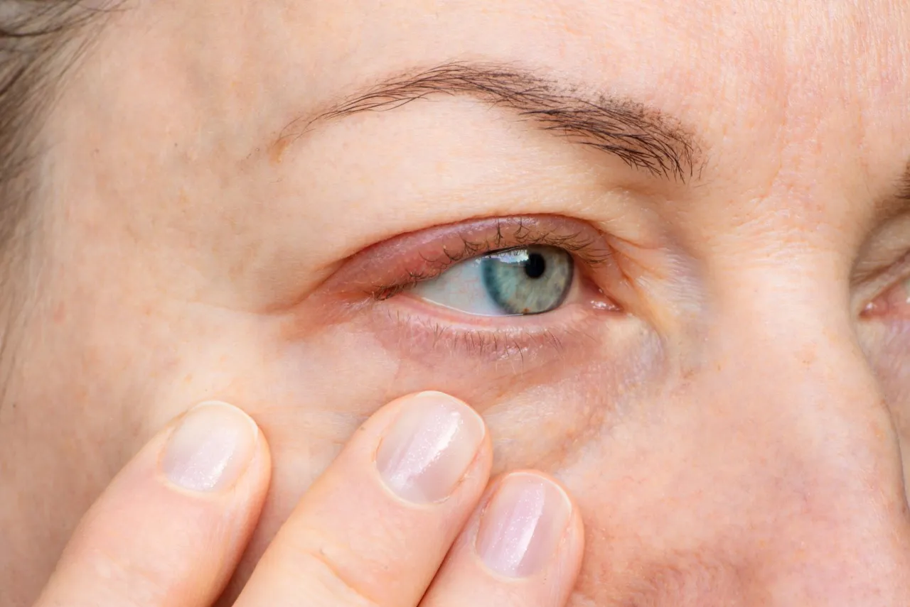 Opuchnięte oczy rano przyczyny