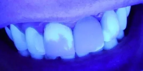 naturalne zęby w świetle UV fluorescencja