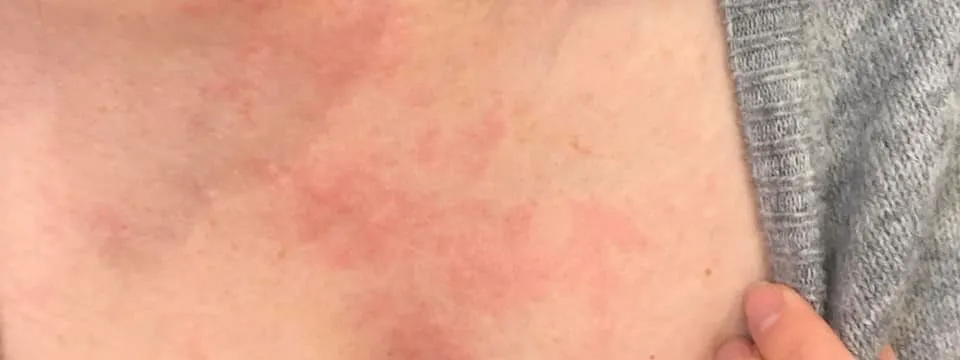 niacyna flush zaczerwienienie sk&oacute;ry