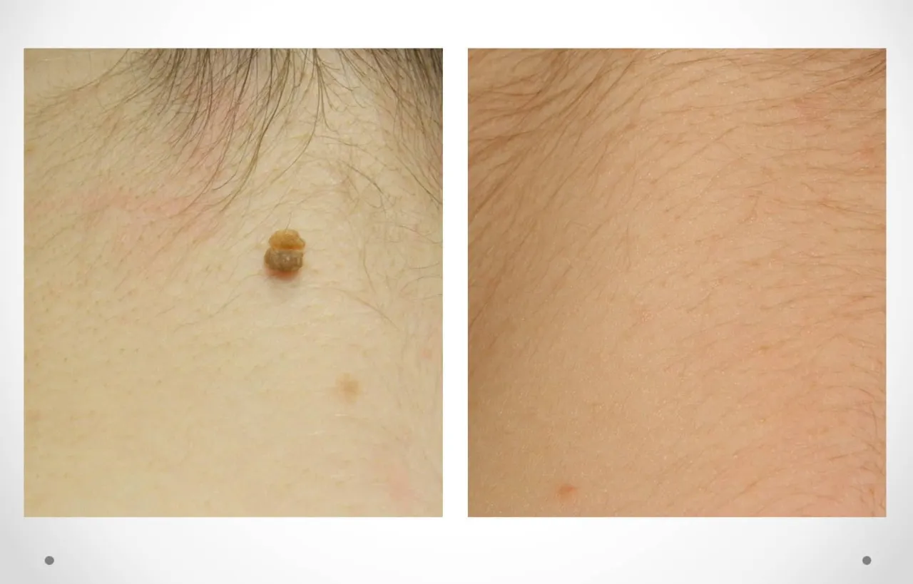 Profesjonalne usuwanie brodawek dermatolog