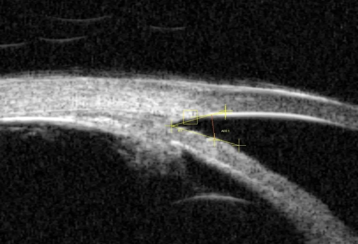 Badania diagnostyczne jaskry - tonometria, perymetria, OCT