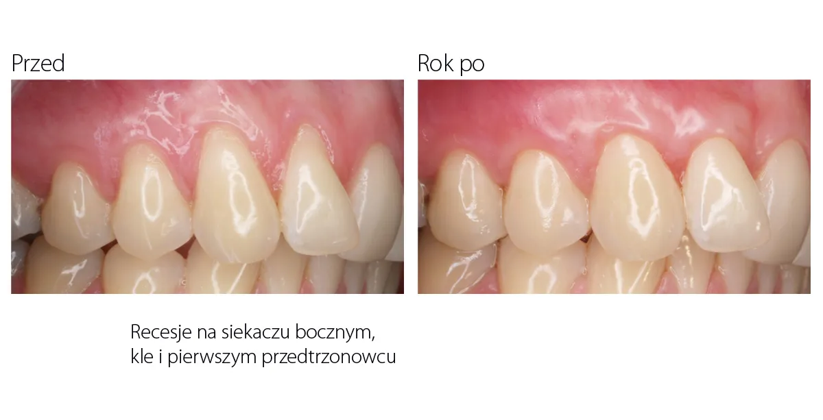 Zdrowe dziąsła a recesja dziąseł porównanie