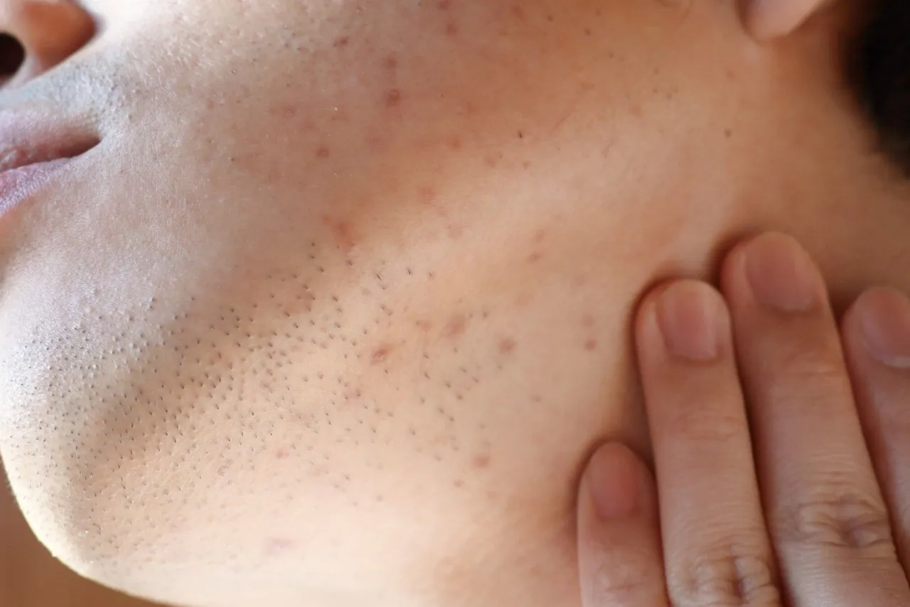 składniki aktywne na przebarwienia po trądziku