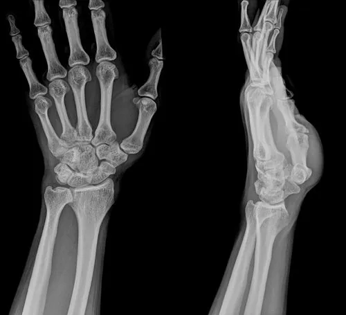 Zdjęcie Jak długo trwa rehabilitacja po złamaniu nadgarstka? Kluczowe informacje