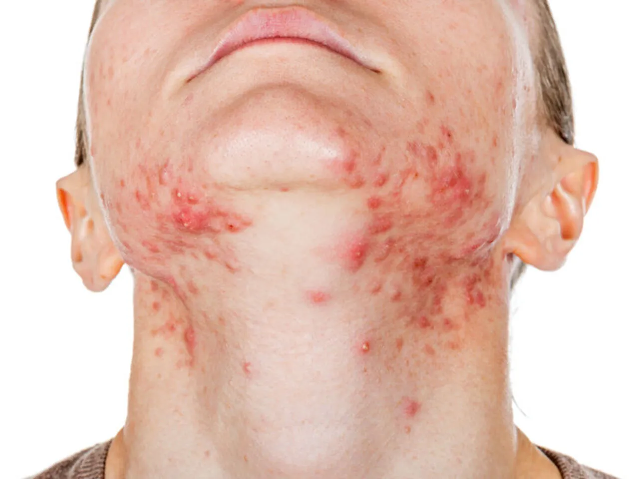 Domowe sposoby na pryszcze