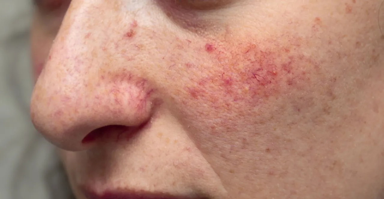 Dermatologe R&ouml;tungen Gesicht