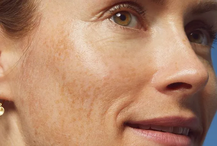 skóra dojrzała zmiany wiekowe