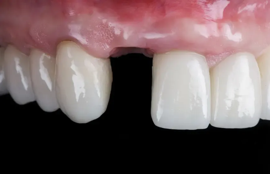 Etapy gojenia dziąsła po ekstrakcji zęba grafika