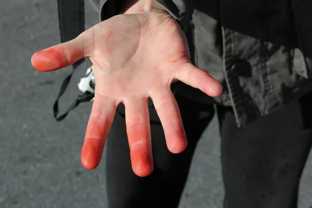 Stopnie odmrożeń objawy zdjęcia